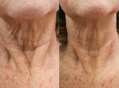 Sarasin Clinic Hifu links voor en rechts na behandeling hals