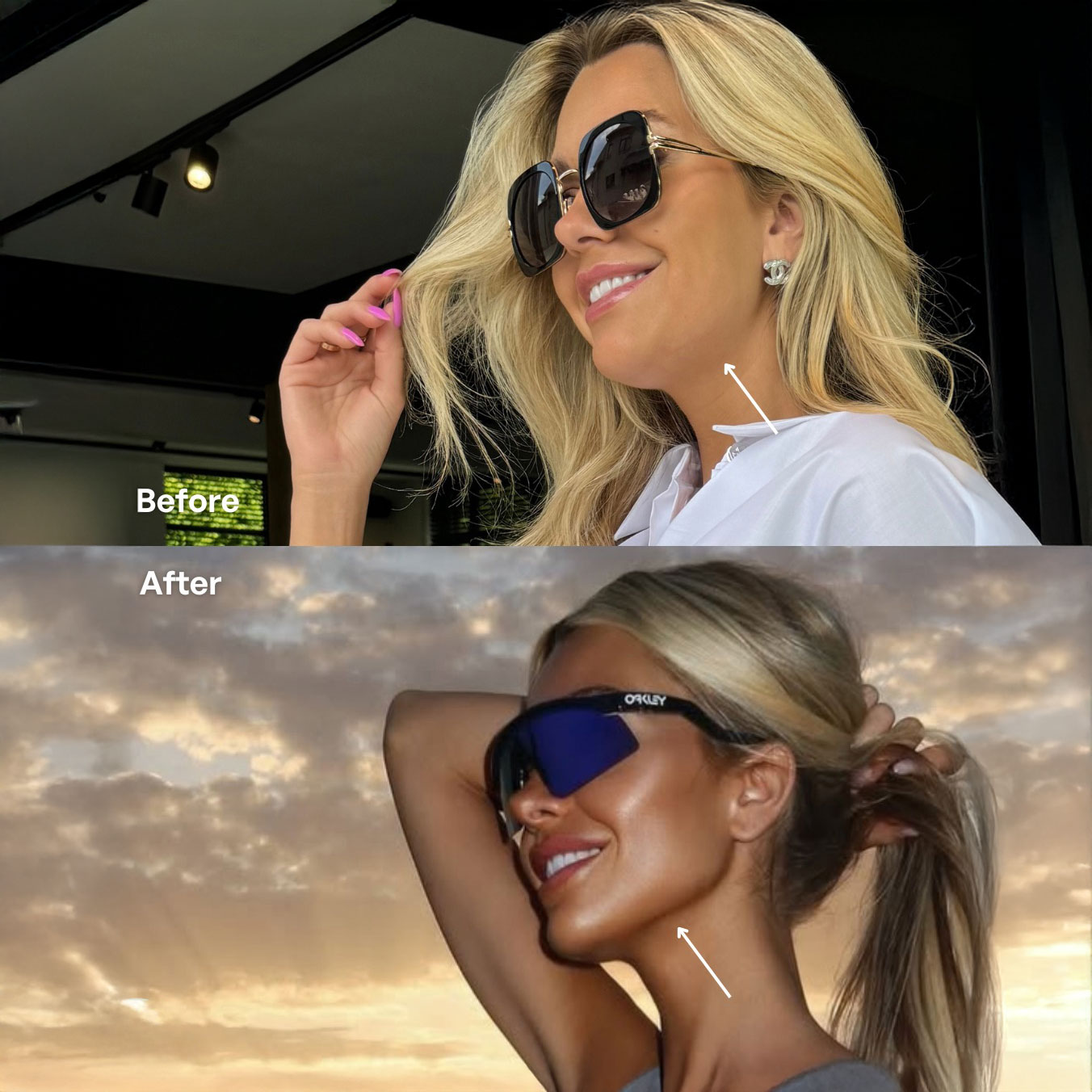 Sarasin hifu voor en na