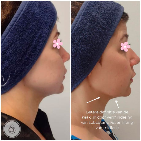 Sarasin Clinic HIFU Face voor en na