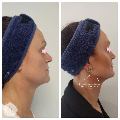 Sarasin Clinic HIFU Face voor en na