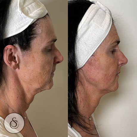 Sarasin Clinic Hifu hals kaaklijn