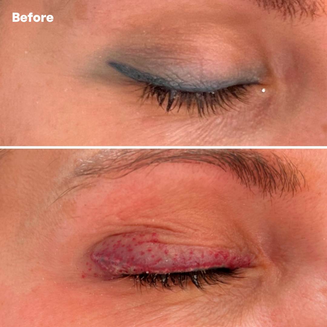 SarasinClinic_PMU-Removal-Eyeliner