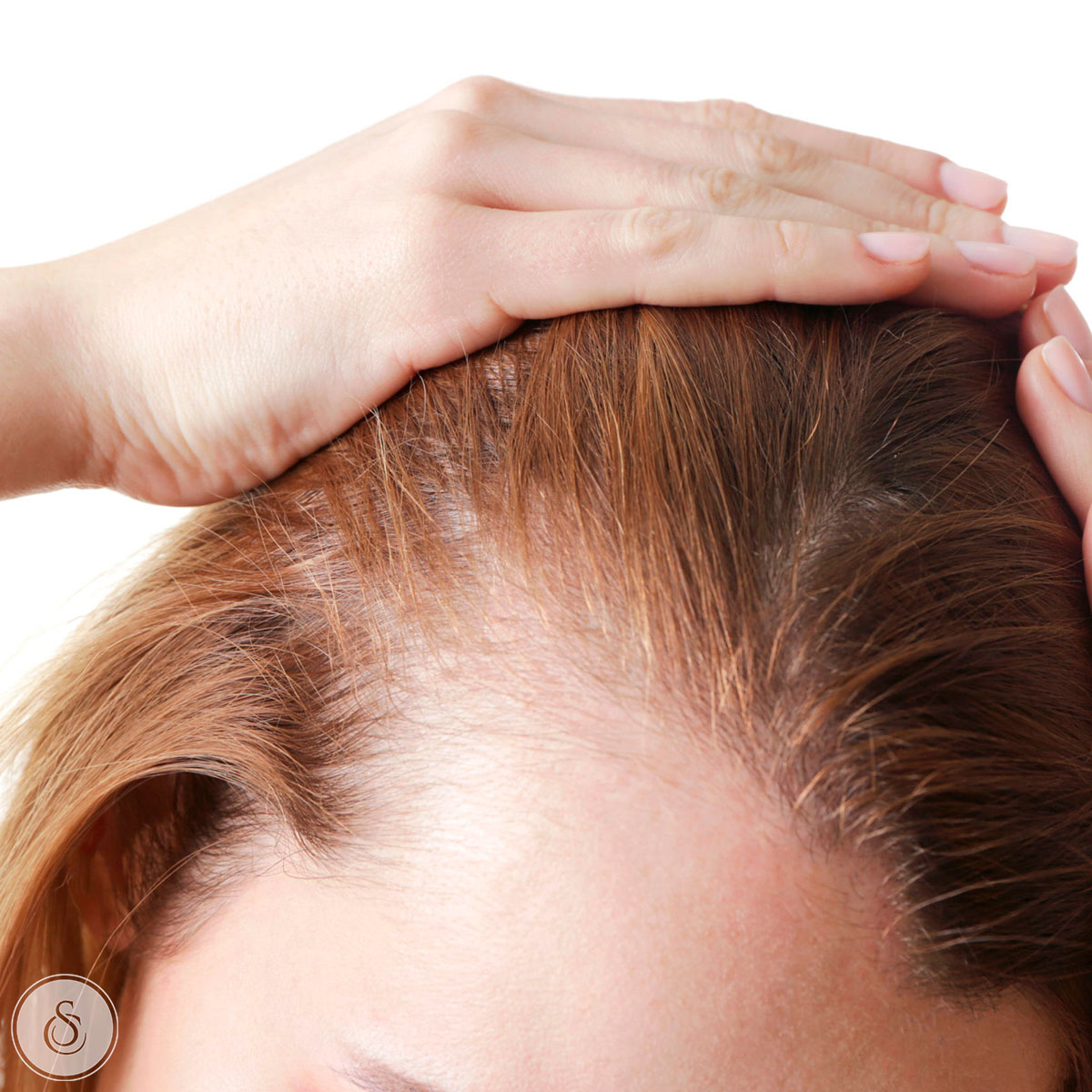 woman with receding hairline