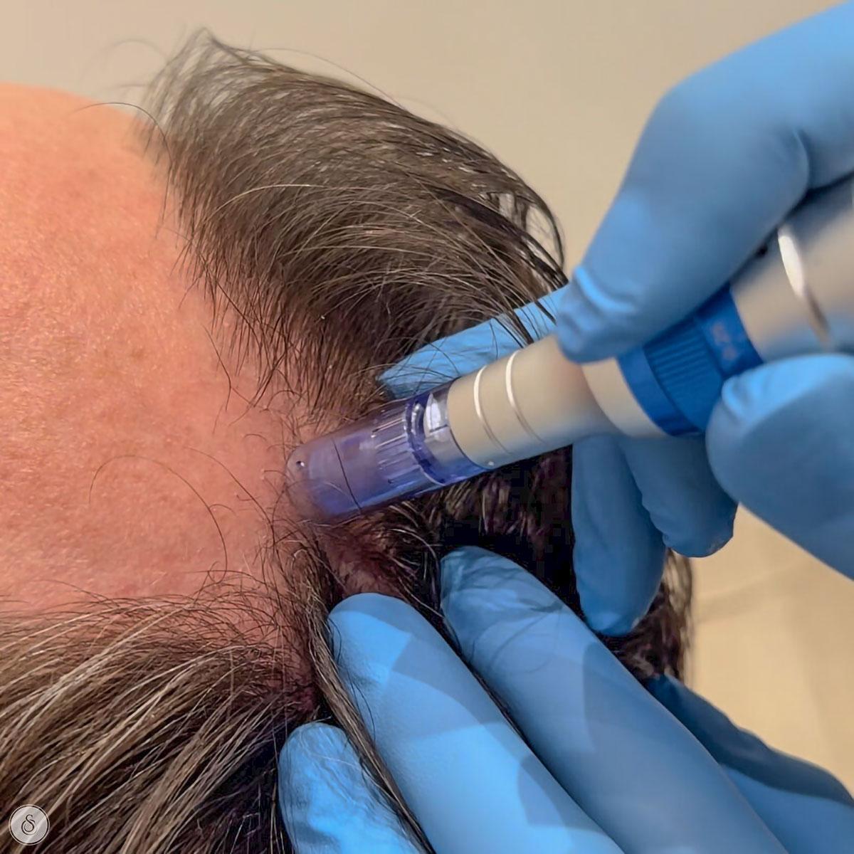 haargroei stimuleren met microneedling